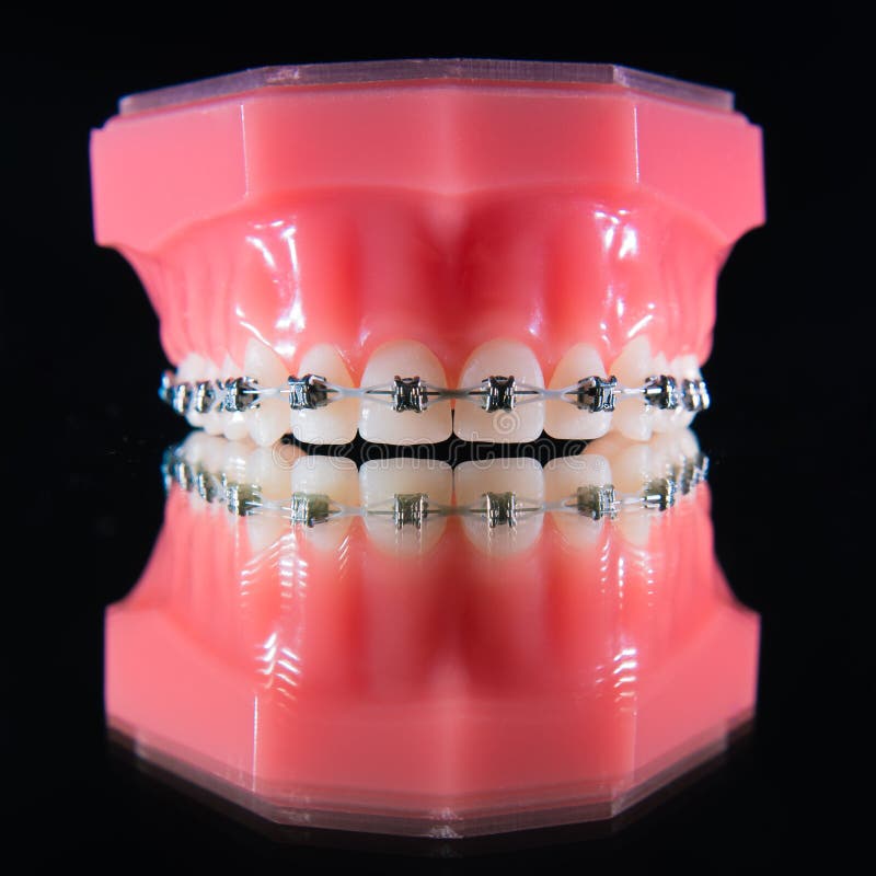The Braces are on the Teeth in the Artificial Jaw on a Black Background