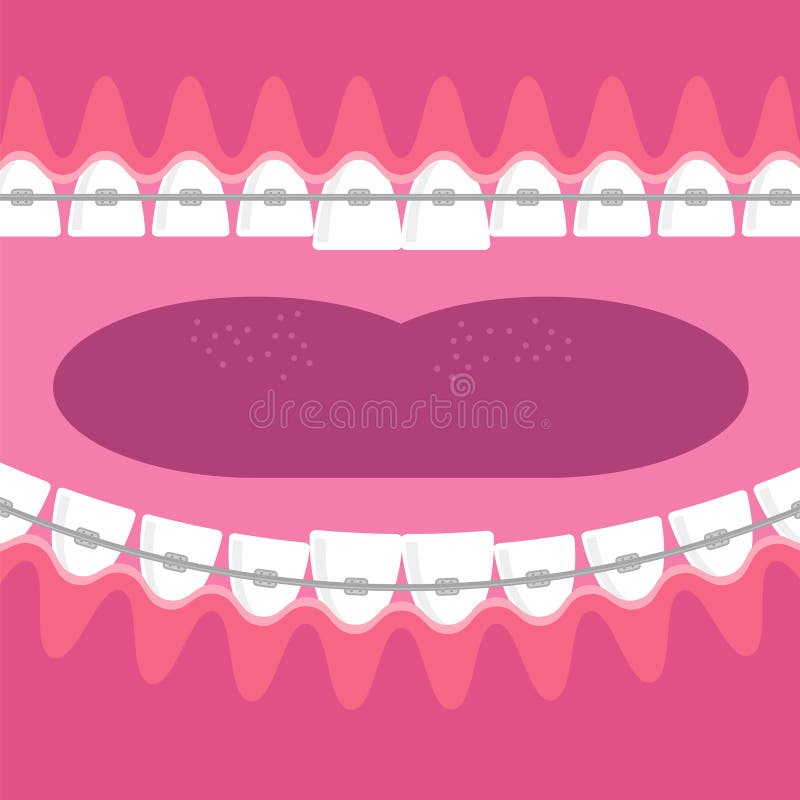 Braces Teeth. Dental Care Background. Orthodontic Treatment. Cartoon Opening Mouth. vector illustration Braces Teeth. Dental Care Background. Orthodontic Treatment. Cartoon Opening Mouth. vector illustration