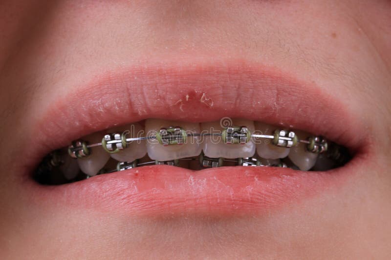 Braces on the teeth close up. The wire on the brackets has bent Stock Photo