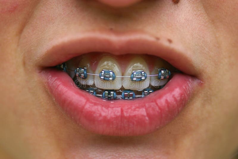 Brackets