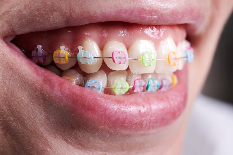 283 Braces Rubber Bands Stock Photos - Free & Royalty-Free Stock