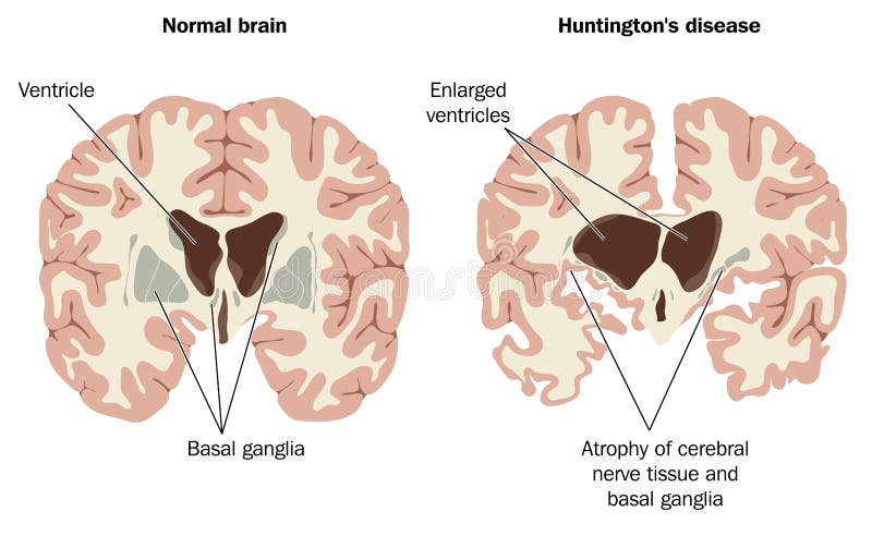 Normálního mozku a mozku s Huntingtonova choroba, ukazuje zvětšené komory a atrofie nervové tkáně a bazálních ganglií.