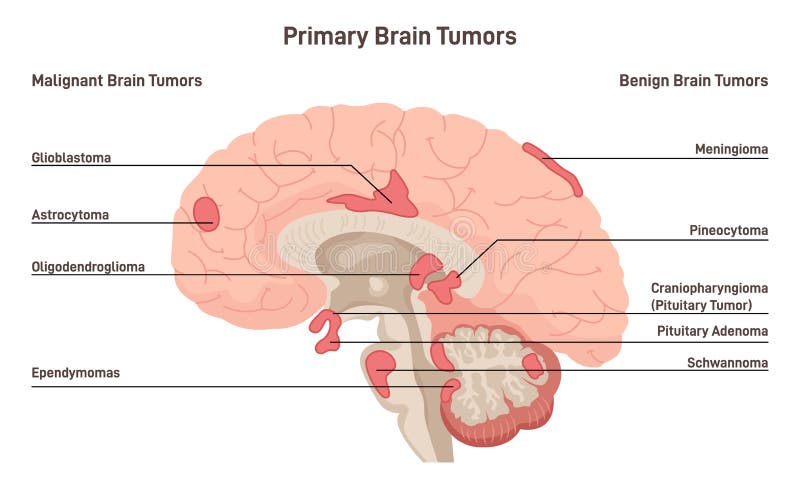 Brain cancer concept. Primary brain tumors types. Malignant cells develop