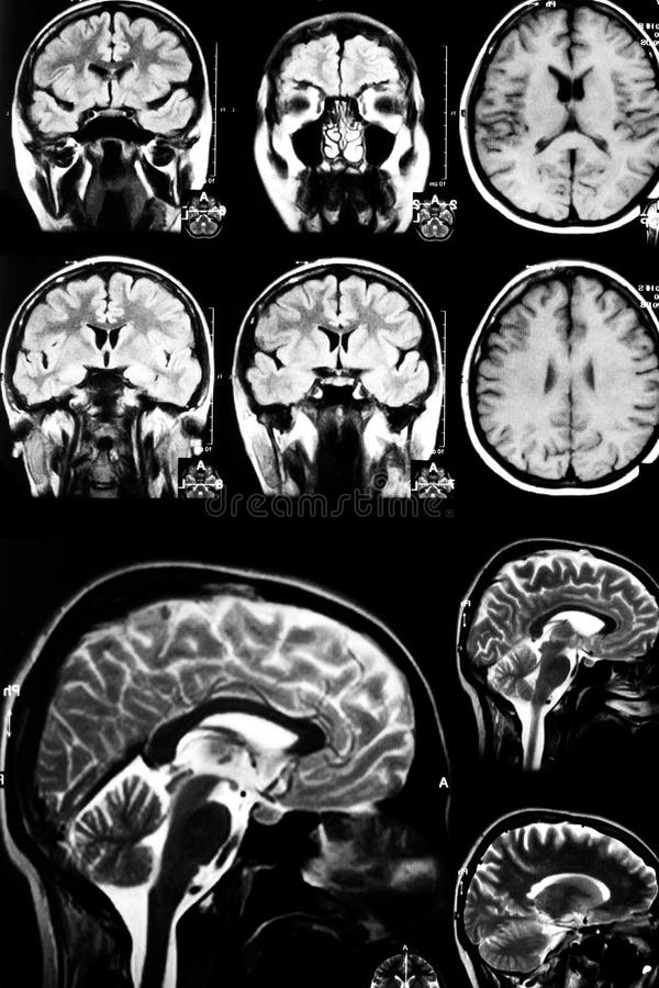 MRI scan of brain. MRI scan of brain