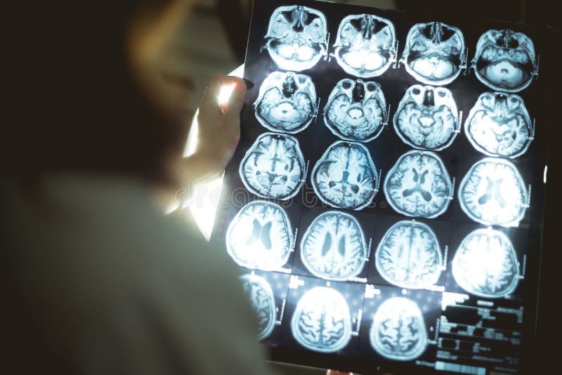 Brain MRI and dementia stock image. Image of brain, sagittal - 105374245