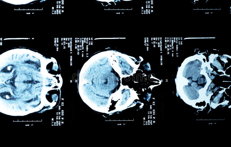 Brain Xrays of an Adult Person Stock Image Image of health, medicine