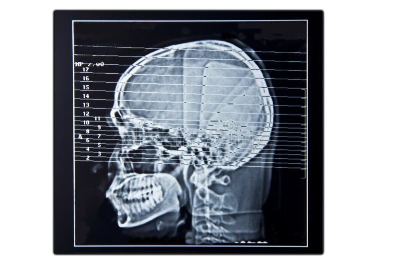 Brain scan with negative film stock images Brain scan with negative film stock images