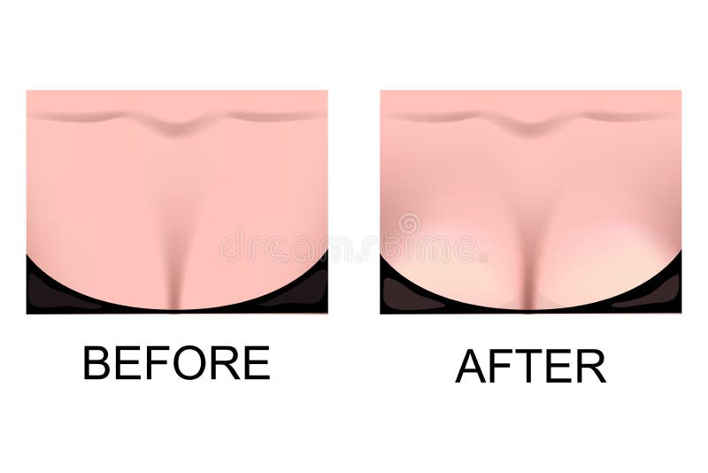 Vector Illustration Breasts before and after Stock Vector