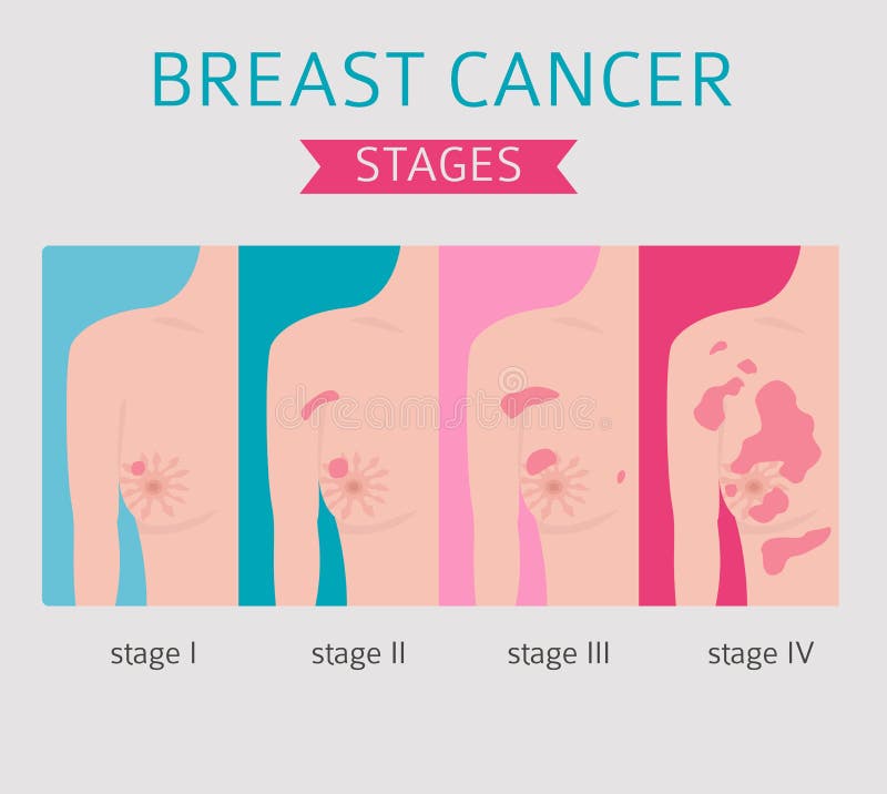 Breast Cancer Medical Infographic Diagnostics Symptoms Treat Stock