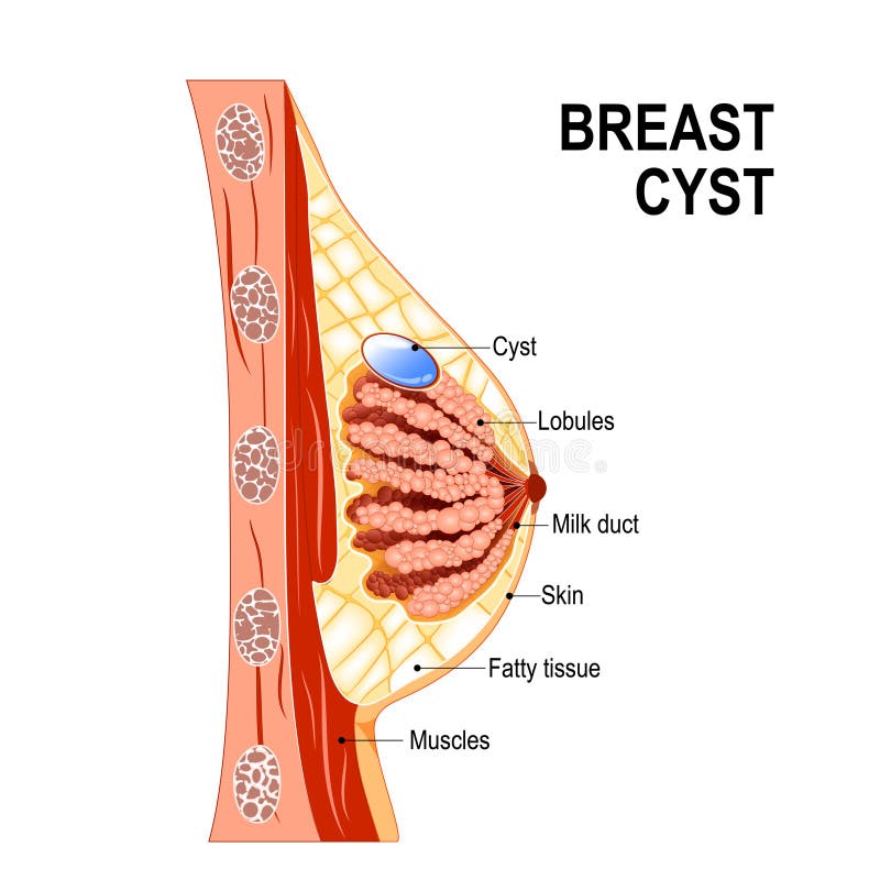 Breast Cancer. Cross-section of the Mammary Gland with Tumor Stock Vector -  Illustration of cancer, carcinoma: 144339815