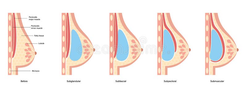 Breast Implant Concept