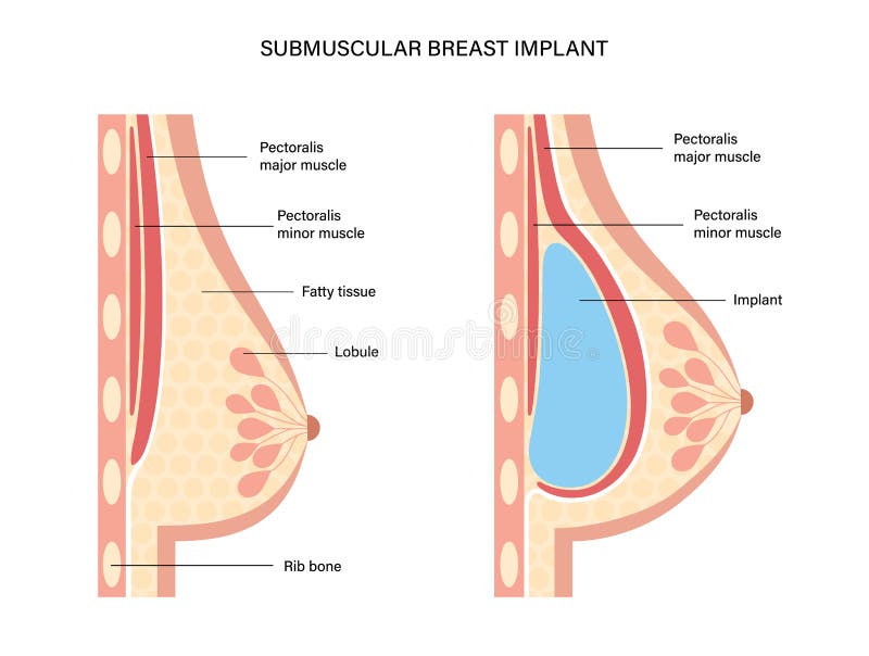 3,473 Breast Implant Size Royalty-Free Images, Stock Photos & Pictures