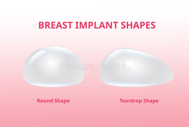 Breast Implant Stock Illustrations – 701 Breast Implant Stock  Illustrations, Vectors & Clipart - Dreamstime