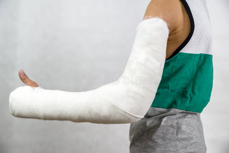 Broken arm in cast.