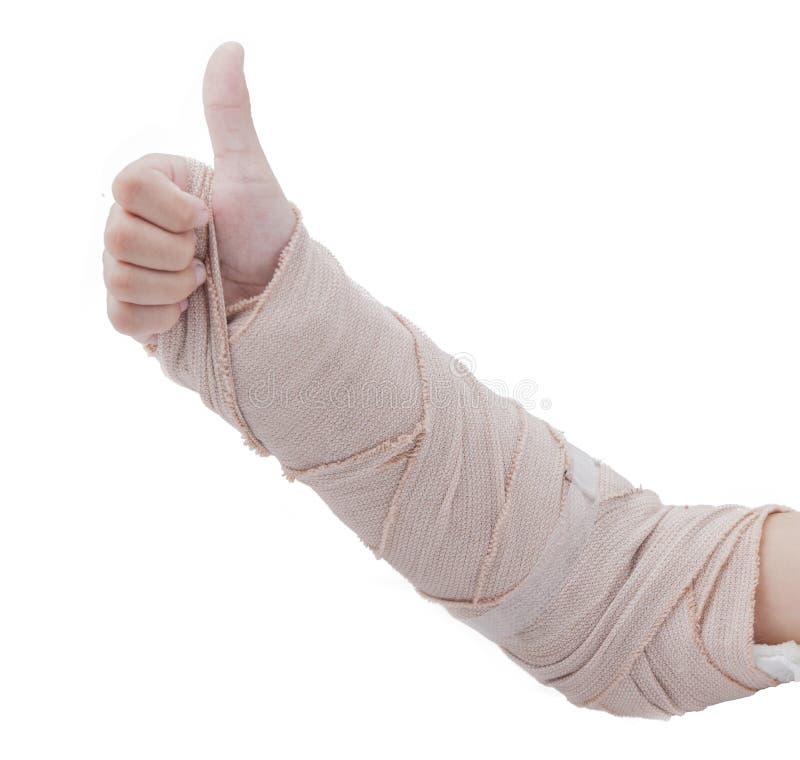 Broken Arm Stock Photo - Download Image Now - Orthopedic Cast, Broken Arm,  Broken - iStock