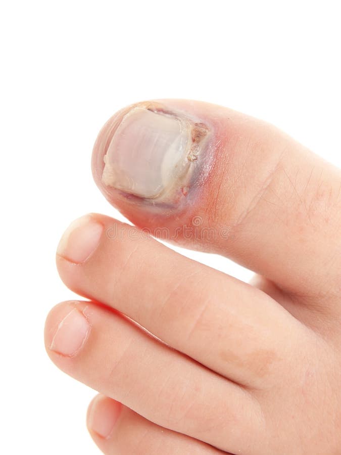 Broken big toe with nail detachment royalty free stock image