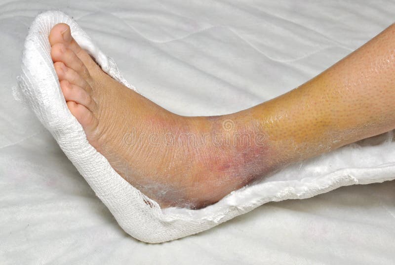 Patient with broken leg in cast.