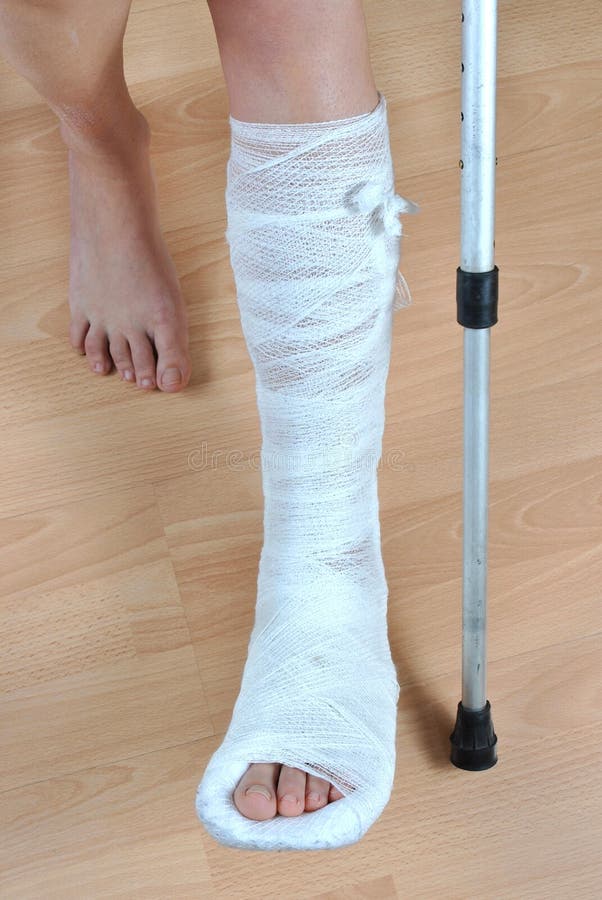 Broken leg stock photo. Image of bandage, leave, ankle - 18399286