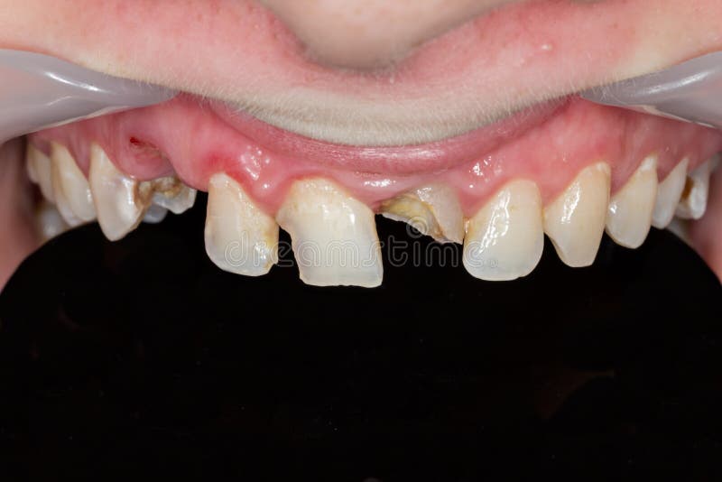 Broken teeth stock image. Image of teeth, decay, dentist 162496189