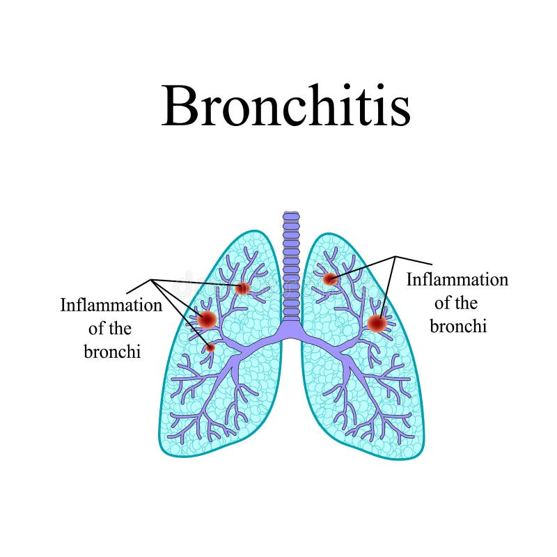 Bronchitis. The anatomical structure of the human stock illustration