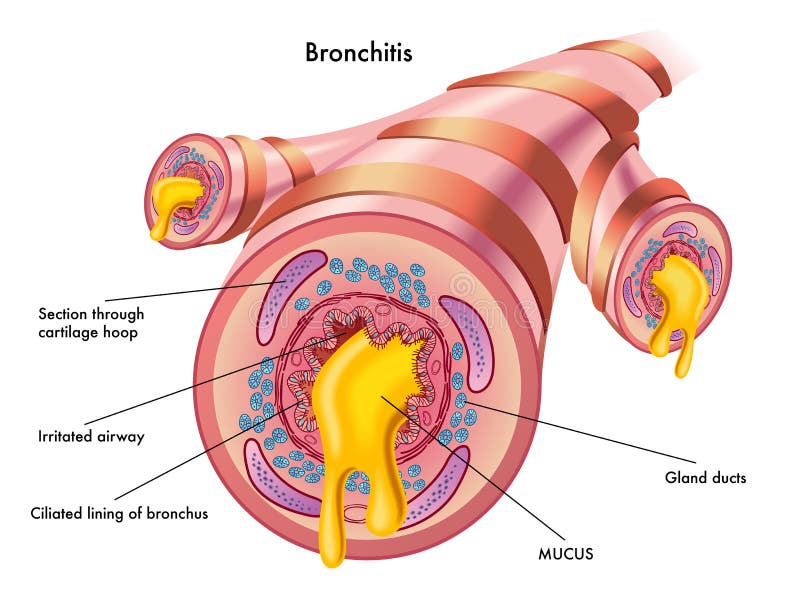 Médico ilustraciones de efectos de bronquitis.