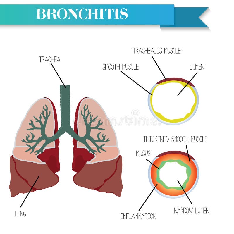 Bronco sano e infiammato Bronchite cronica illustrazione vettoriale Bronco sano e infiammato Bronchite cronica illustrazione vettoriale