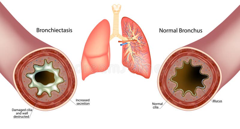 Bronkiectos och normal bronchus. ökad sekretionsslam. Skadad och skadad cilia stock illustrationer
