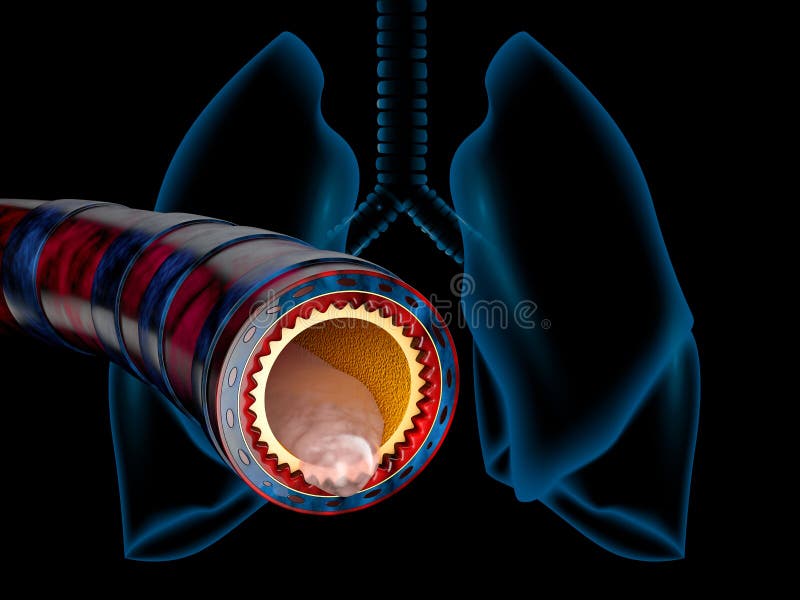 Bronchitis Anatomy, Mucus Secreted As A Chest Cold As A 3D Illustration
