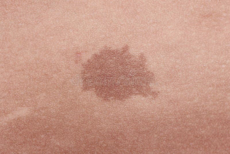 Brown birthmark obrazy royalty free Brown birthmark obrazy royalty free
