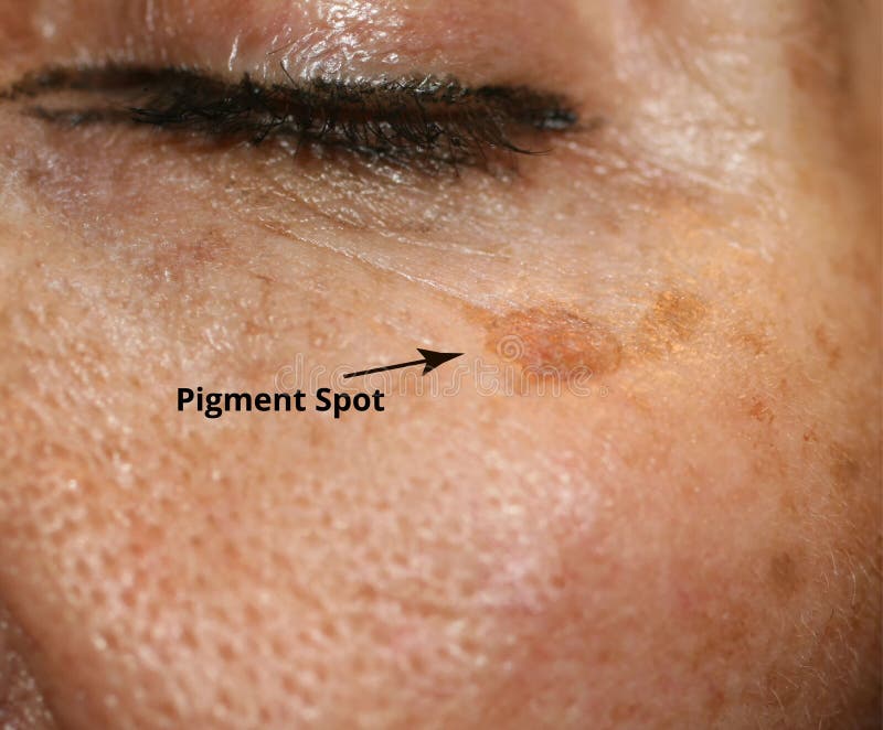 skin pigmentation brown patches