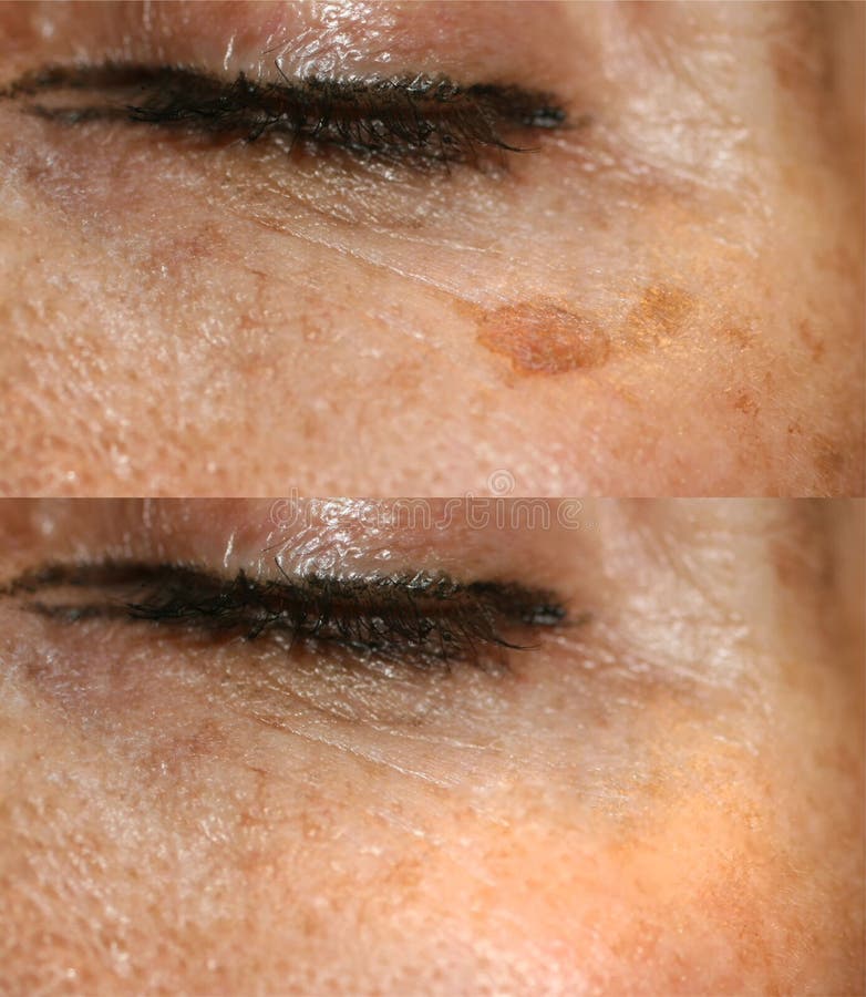 Brown spot on the skin of the face. Pigmentation on the skin. After laser removal