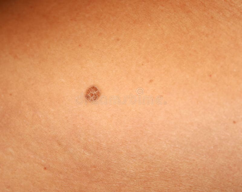 Brown Spots On The Skin Spot Dark Stock Photo Image Of Condition