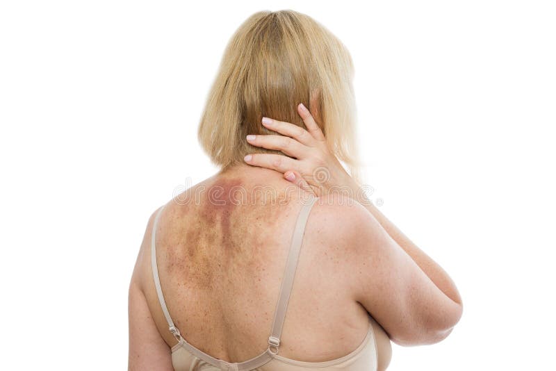 A Bruise on the Back, a Woman with Extensive Hematoma after a Massage Stock  Image - Image of massage, domestic: 121845693