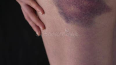 Bruises Stock Footage ~ Royalty Free Stock Videos