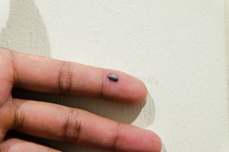 Subcutaneous Hematoma Close Up. Finger Injury Trauma Cause by Hitting