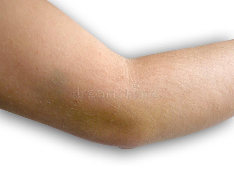 The Bruise On My Elbow. Pain In The Elbow. The Woman Holds Her Hand