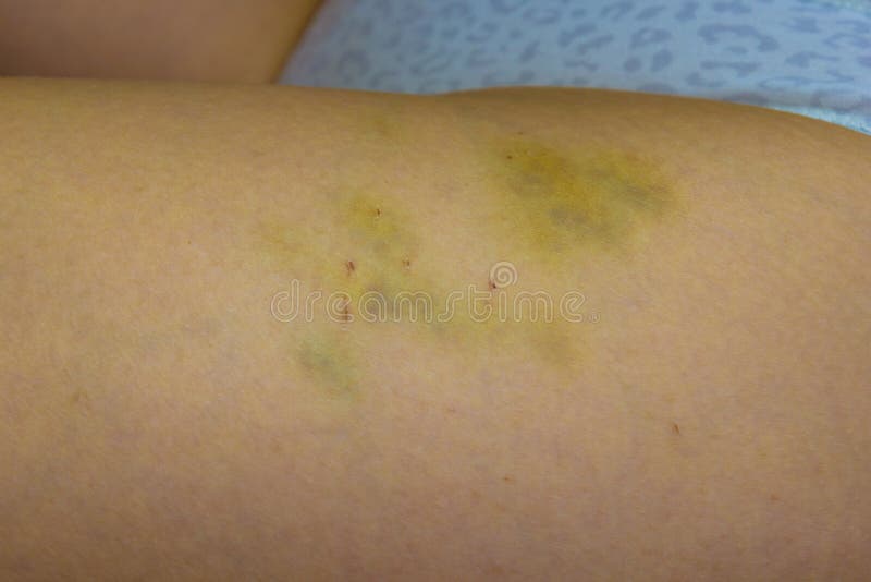 Bruising no reason for yellow Common Causes