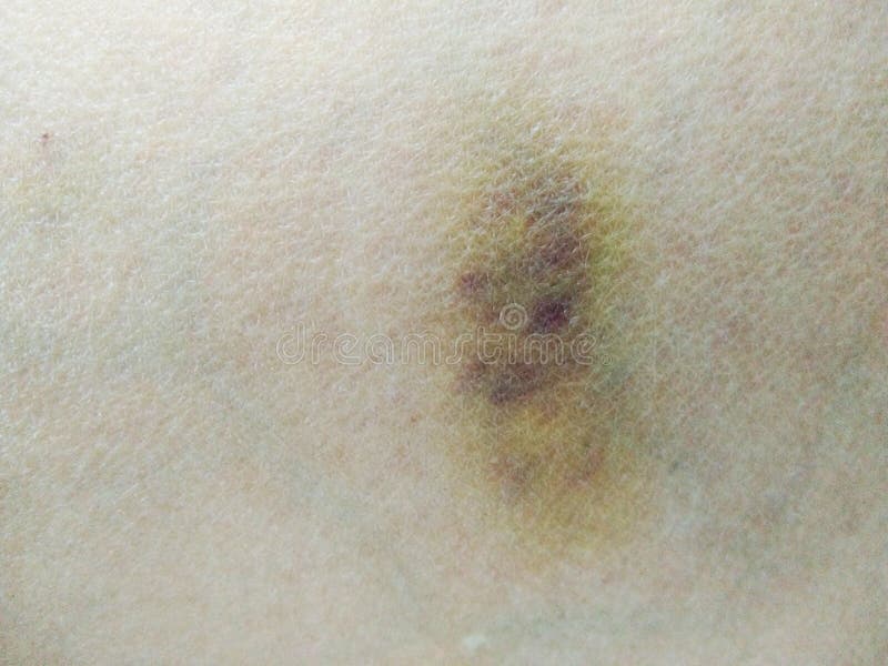 Bruise on skin stock photo. Image of injure, skins, discoloration
