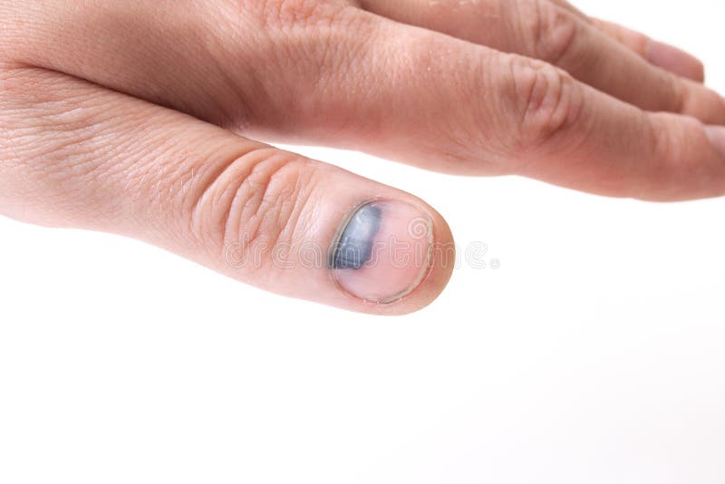 Bruise Under the Nail on the Thumb Stock Image Image of closeup, hand