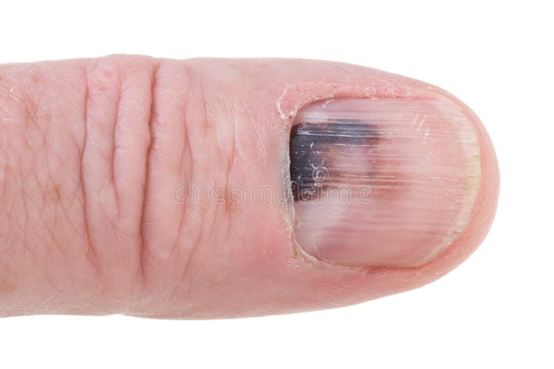 Bruised nails | Felix E. Guerrero | Flickr