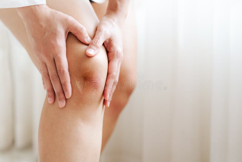 Bruised knee of asia woman, selective focus royalty free stock photography Bruised knee of asia woman, selective focus royalty free stock photography