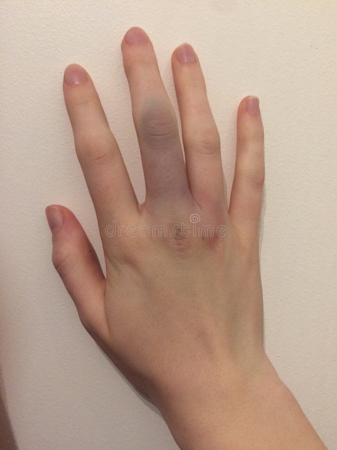 Bruises stock photo. Image of pain, bruised, hand, bruises 124265136