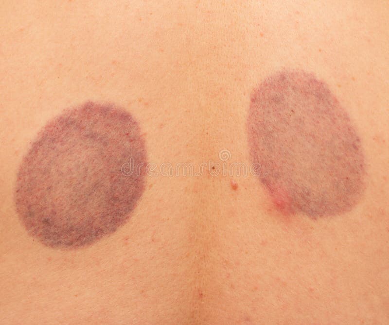 Bruises on the Skin of the Back Stock Photo Image of medicine, inflammation 230885020