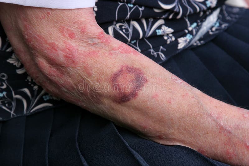 Livido e sceriosis sul braccio di una anziana di sesso femminile.