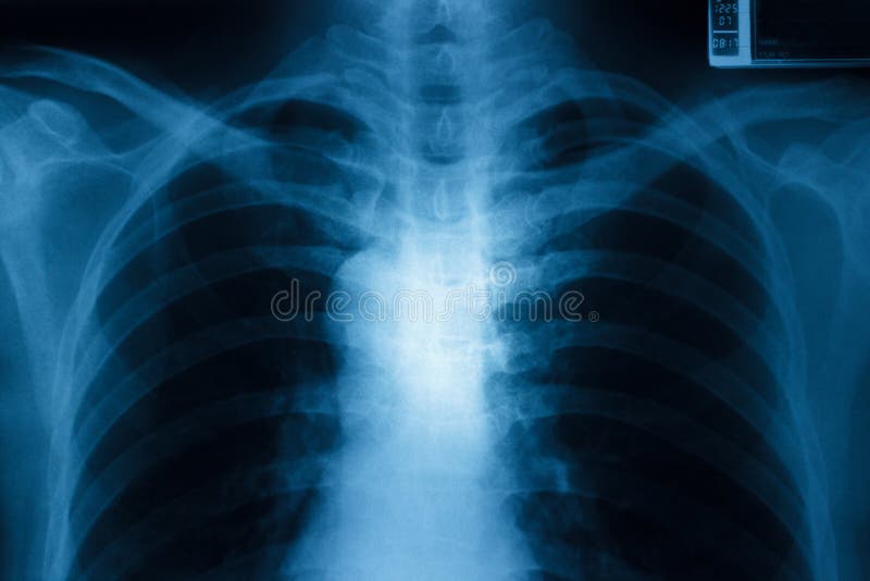 Brustradiographie stockfoto Brustradiographie stockfoto