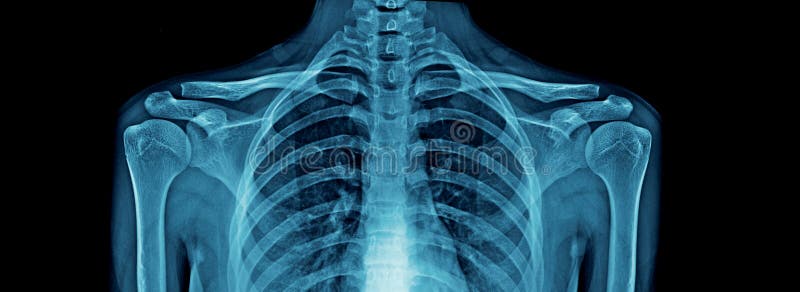 Brustradiographie der hohen Qualität und Schulter und Schlüsselbein lizenzfreies stockbild Brustradiographie der hohen Qualität und Schulter und Schlüsselbein lizenzfreies stockbild