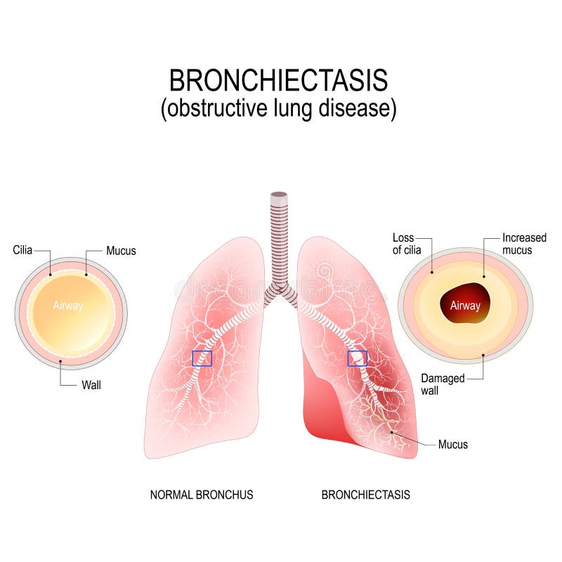 Brônquio e bronquectasia normais doença pulmonar obstrutiva ilustração royalty free Brônquio e bronquectasia normais doença pulmonar obstrutiva ilustração royalty free