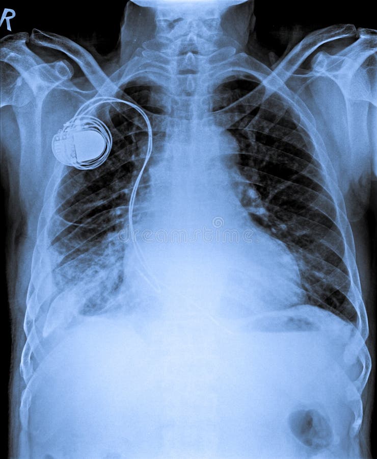 Bröstkorg X Ray med hastighetstillverkaren royaltyfria bilder Bröstkorg X Ray med hastighetstillverkaren royaltyfria bilder