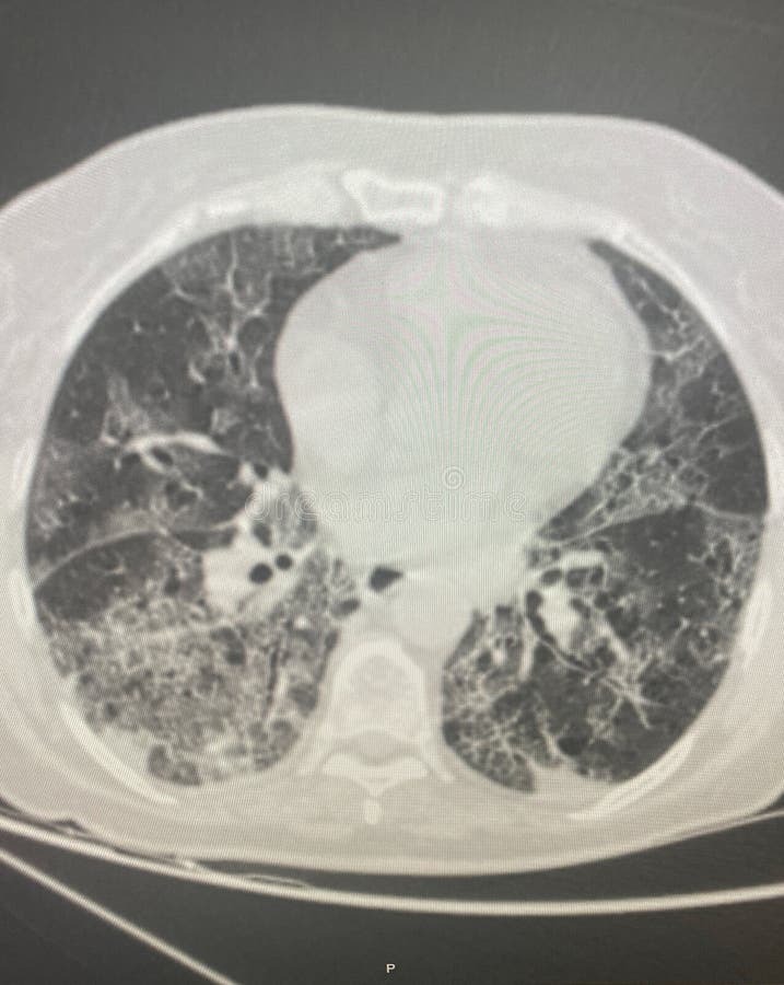 Ground Glass, opacities, crazy-paving, adenovirus pneumonia shows bilateralmultifocal GGO with patchy consolidations on CT image. May show lower or segmental distribution indicative of bronchopneumonia that reselles bacterial pneumonia. Ground Glass, opacities, crazy-paving, adenovirus pneumonia shows bilateralmultifocal GGO with patchy consolidations on CT image. May show lower or segmental distribution indicative of bronchopneumonia that reselles bacterial pneumonia.