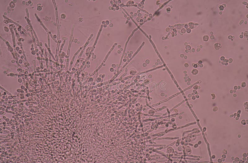 Budding Yeast Cells with Pseudohyphae in Urine Sample. Stock Photo